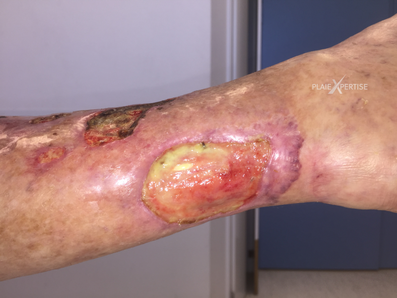 Fichier:Tendon-Voussure12.png