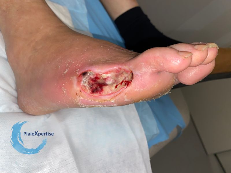 Fichier:Amputation3.jpg