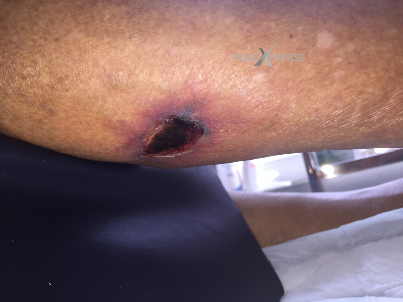 Fichier:Angiodermite typique27.png