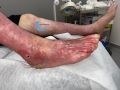 Dermite d'irritation118.jpg
