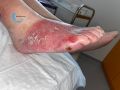 Dermite d'irritation147.jpg