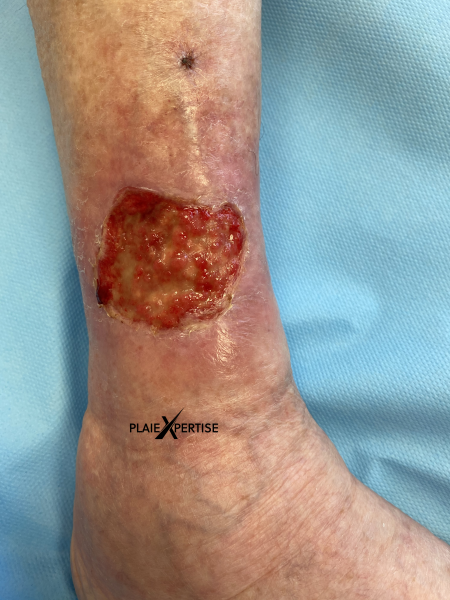 Fichier:Tissu de granulation normal17.png