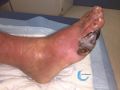 Pied infecté49.jpg