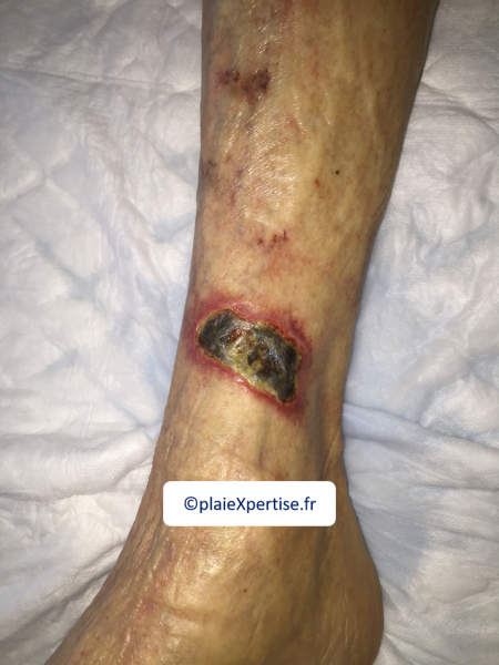 Fichier:Angiodermite typique11.png