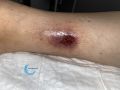 Angiodermite typique110.jpg