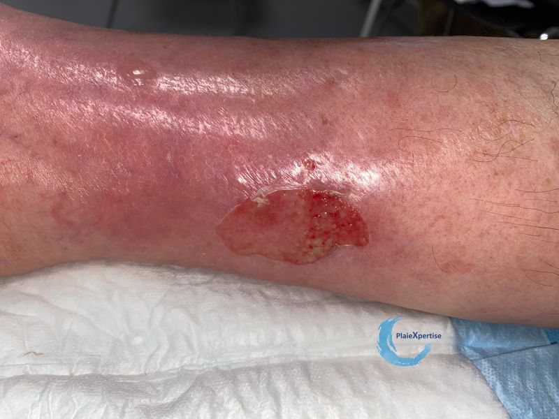 Fichier:Erosions post bulleuses9.jpg