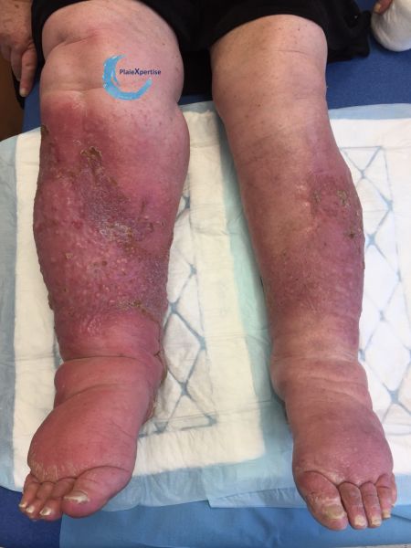 Fichier:Grosses jambes suintantes28.jpg
