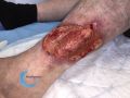 Tendon-Voussure21.jpg