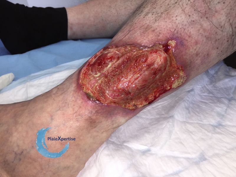 Fichier:Tendon-Voussure21.jpg
