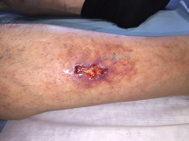 Fichier:Angiodermite typique23.png
