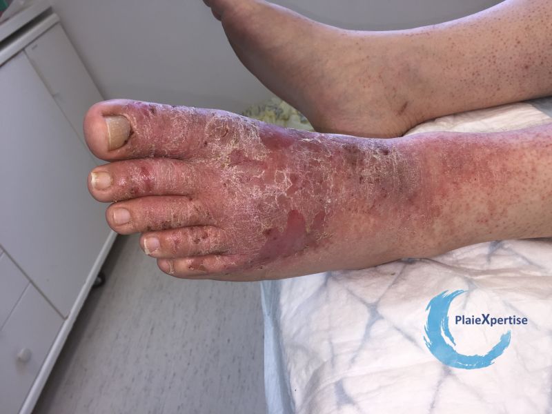 Fichier:Eczéma109.jpg