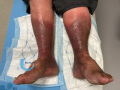 Dermiteocre54.png
