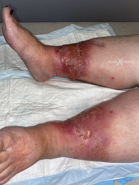 Fichier:Hypodermite chronique35.png