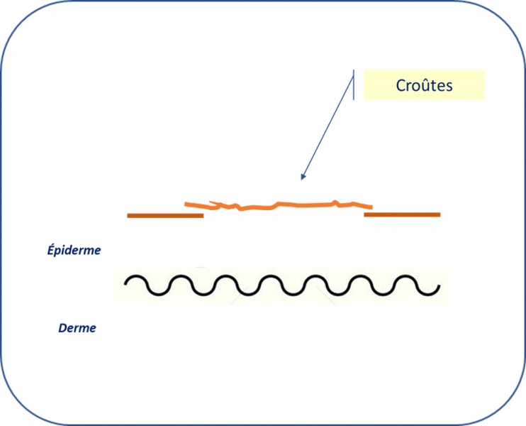 Fichier:Croûtes.png
