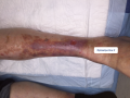Dermiteocre14.png