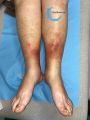 Hypodermite chronique57.jpg