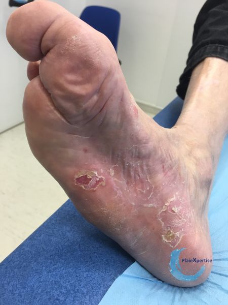 Fichier:Pied déformé7.jpg