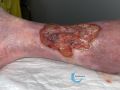 Tissu de granulation inflammatoire54.jpg