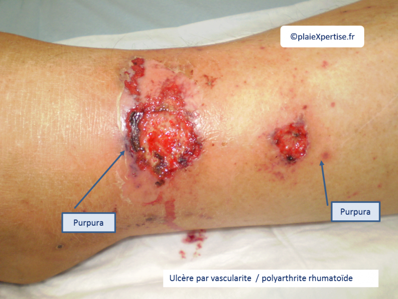 Fichier:Vascularite1.png