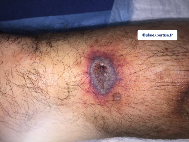 Fichier:Vascularite7.png