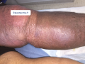 Hypodermite chronique9.png