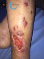 Pyoderma gangrenosum36.jpg