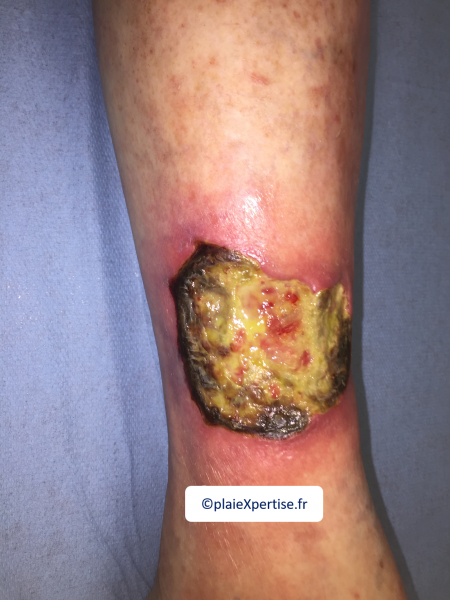Fichier:Angiodermite typique22.png