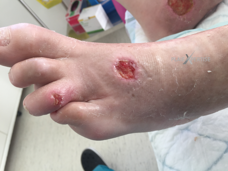 Fichier:Cou de pied34.png