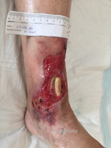 Fichier:Cou de pied43.png