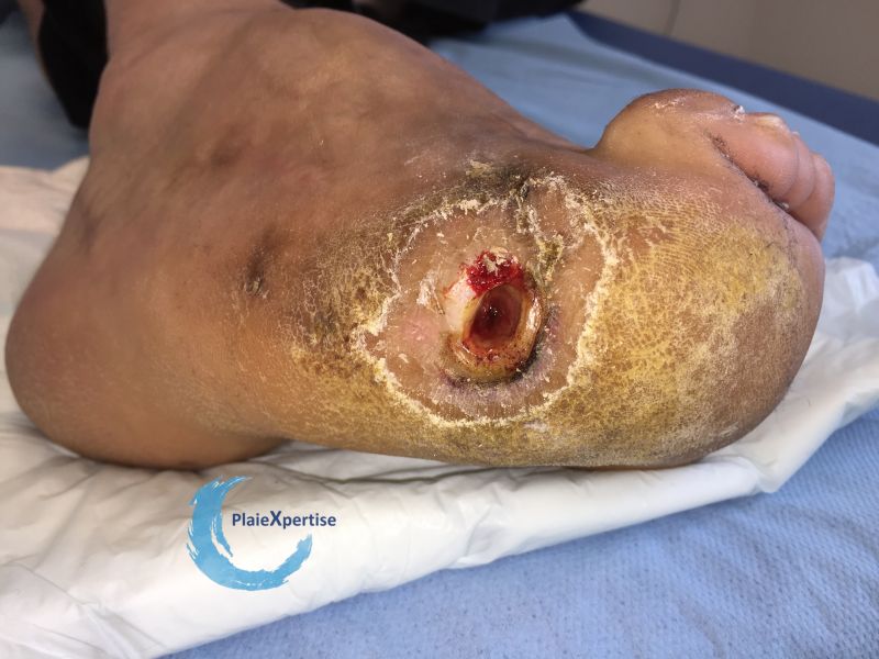 Fichier:Pied de Charcot27.jpg