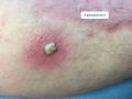 Pustules9.png
