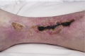Sclerotherapy2.jpg