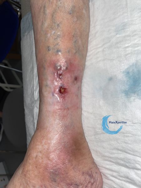 Fichier:Calcifications42.jpg