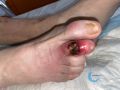 Pied infecté15.jpg