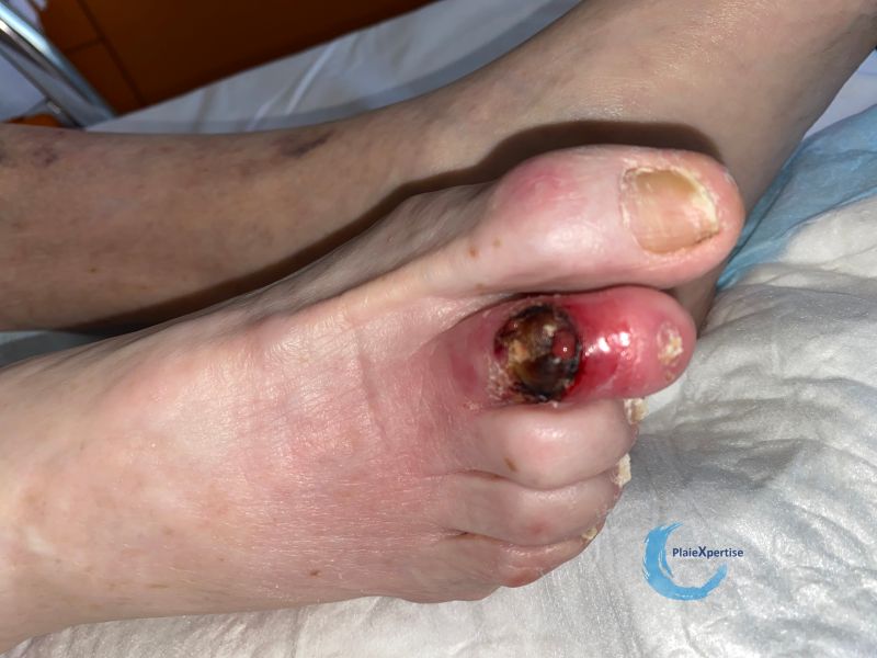 Fichier:Pied infecté15.jpg