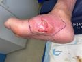 Pied infecté25.jpg