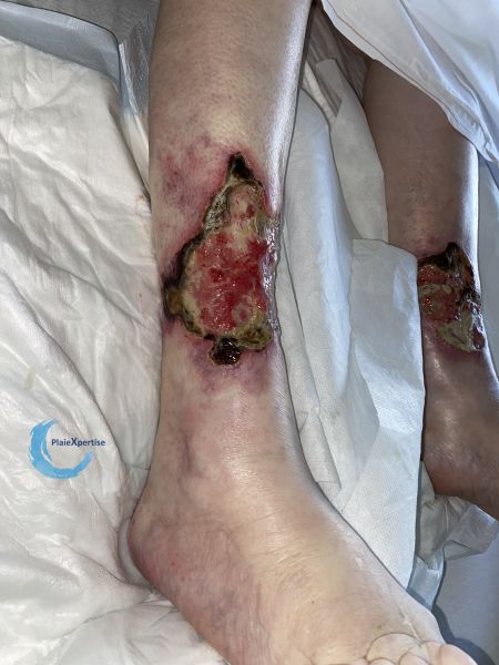 Fichier:Angiodermite typique107.jpg