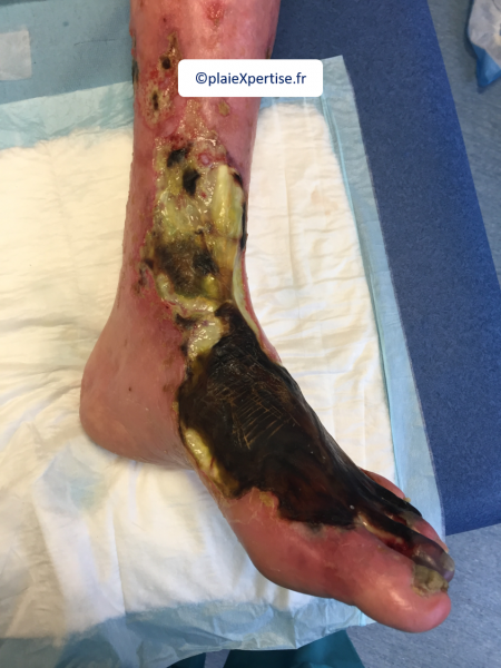 Fichier:Cou de pied2.png