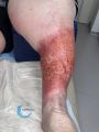 Dermite d'irritation106.jpg