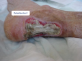 Tendon nécrotique humide10.png