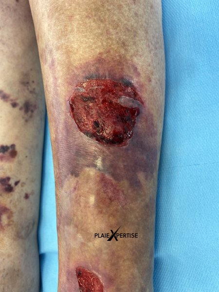 Fichier:Dermatoporose22.png