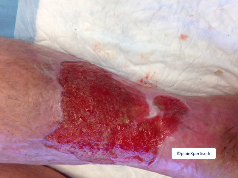 Fichier:Tissu de granulation normal2.png