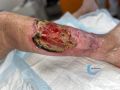 Angiodermite typique139.jpg