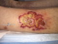 Pyoderma gangrenosum17.png
