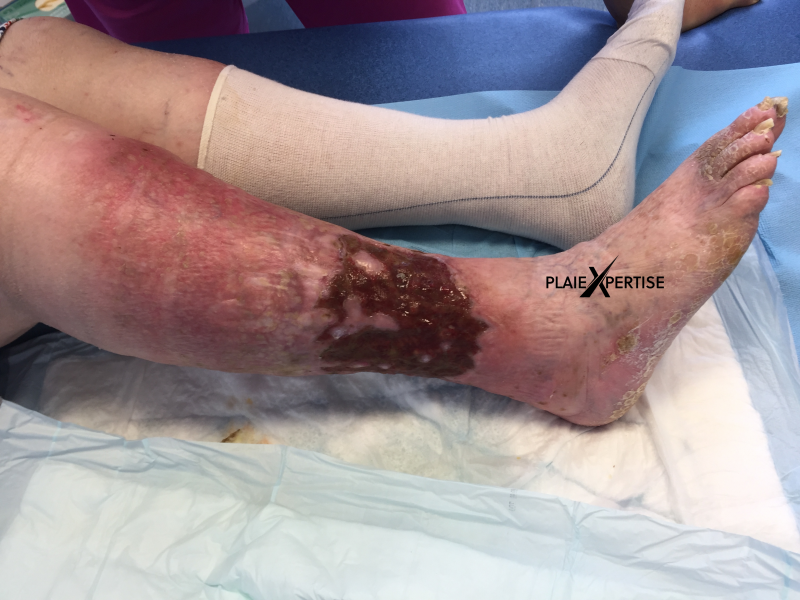 Fichier:Tissu de granulation inflammatoire24.png
