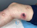 Calciphylaxie17.jpg
