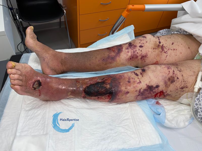 Fichier:Dermatoporose47.jpg