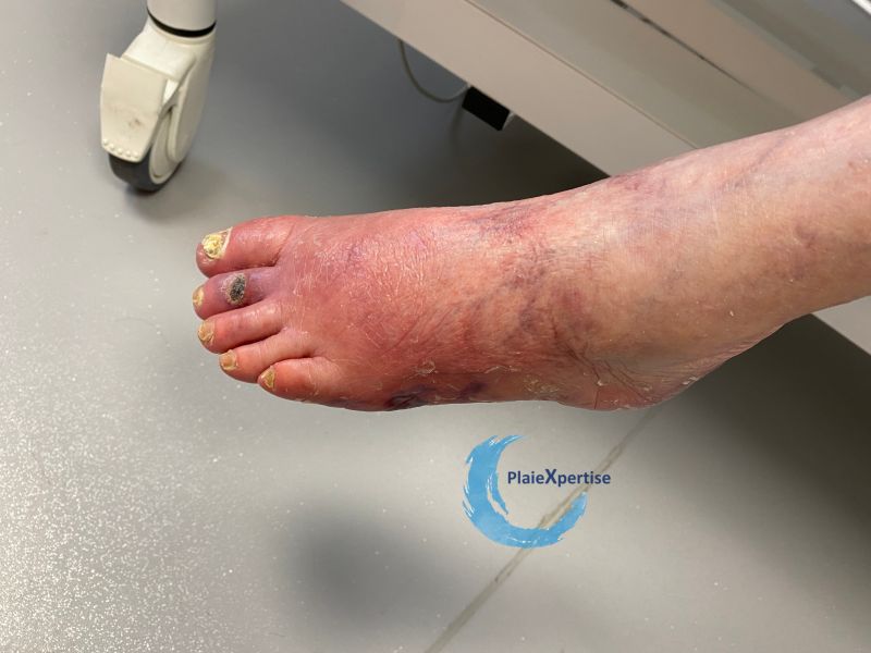Fichier:Erythrocyanose10.jpg