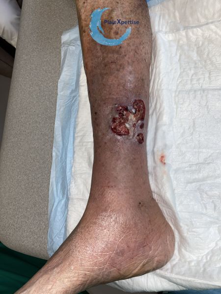 Fichier:Pyoderma gangrenosum33.jpg