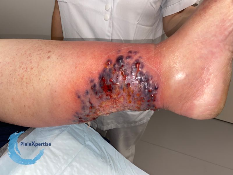 Fichier:Pyoderma gangrenosum40.jpg